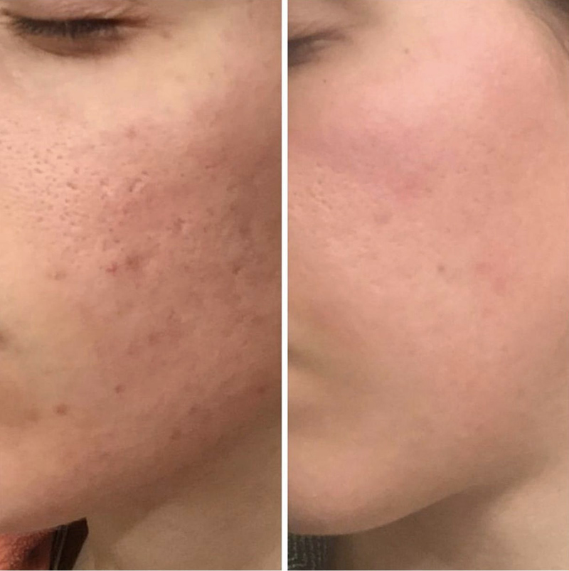 Needling-acne