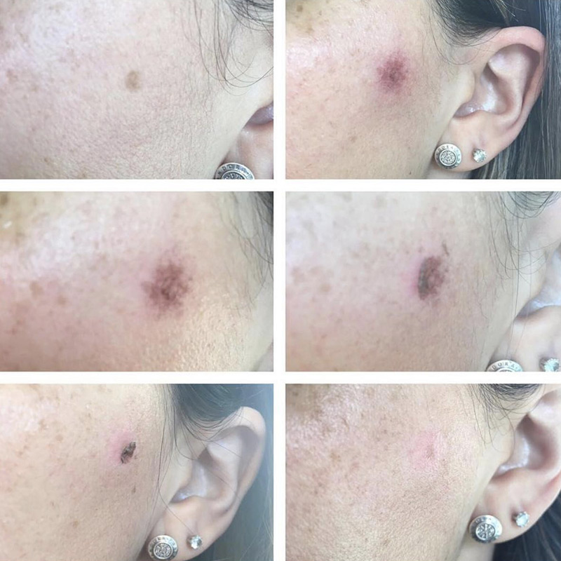 needling-macchie