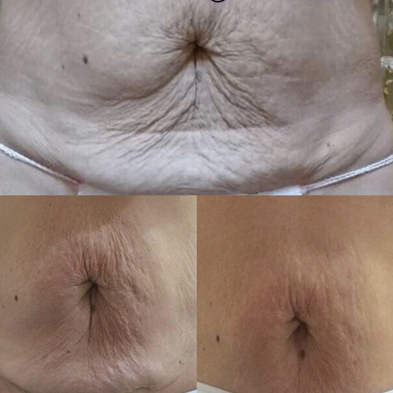 needling