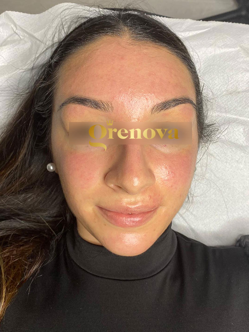 microneedling