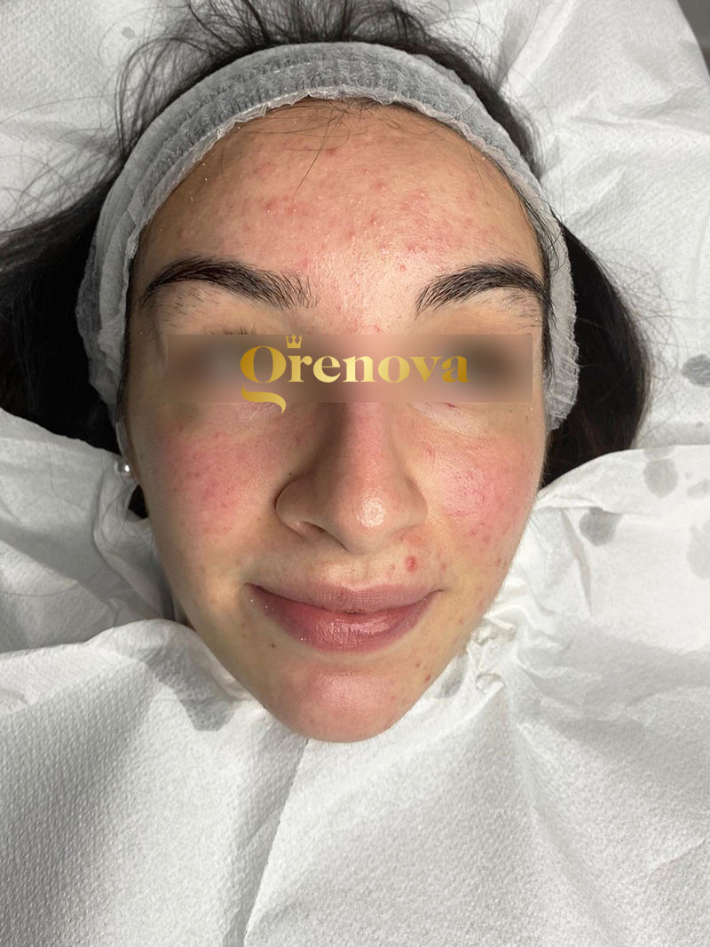 needling-viso-acne