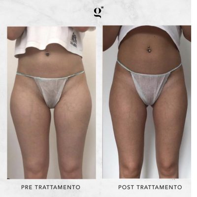 trattamenti-per-snellire-gambe